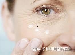 眼部细纹图片,眼部细纹成因解析与改善策略